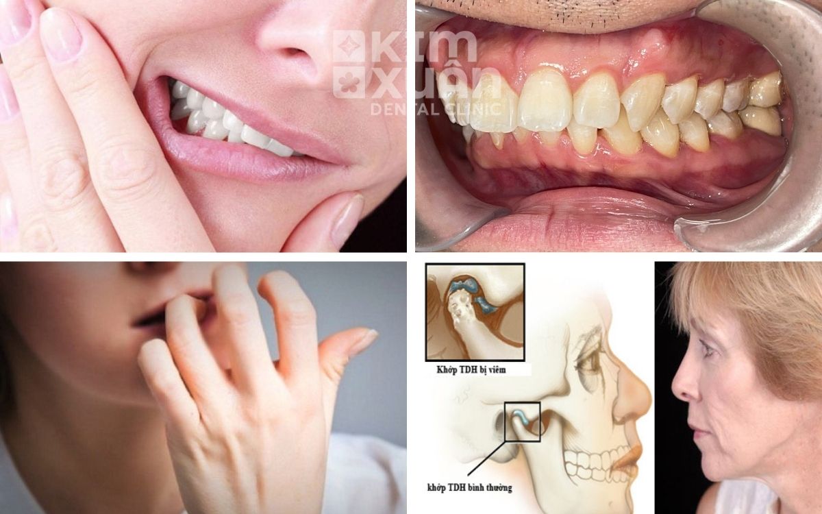 Nguyên Nhân Gây Rối Loạn Khớp Thái Xương Hàm