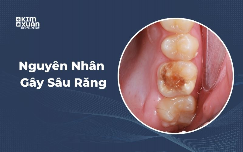 Nguyên Nhân Gây Sâu Răng