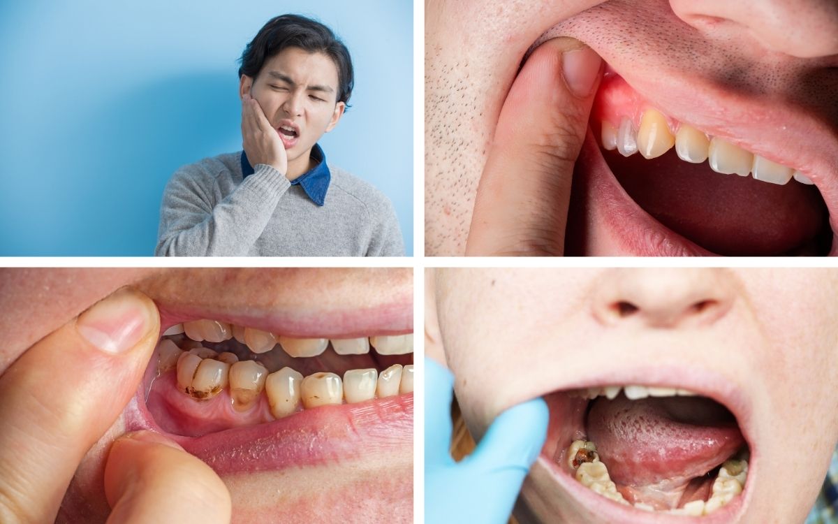 Nguyên Nhân Gây Sâu Răng Đến Tủy
