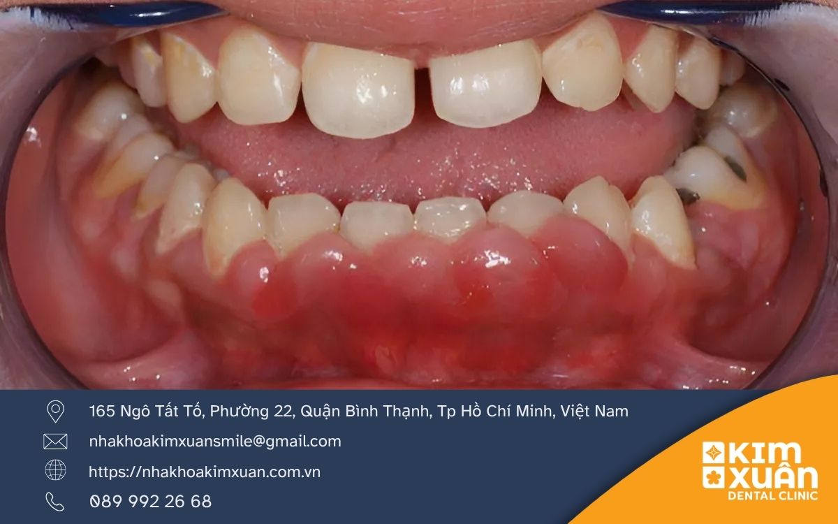 Nguyên Nhân Gây Sưng Nướu
