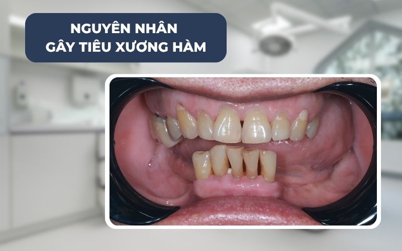 Nguyên Nhân Gây Tiêu Xương Hàm
