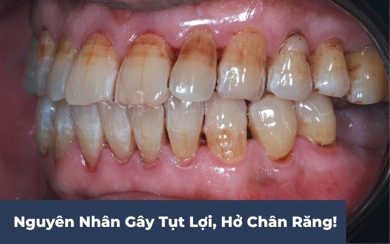 Nguyên Nhân Gây Tụt Lợi Hở Chân Răng