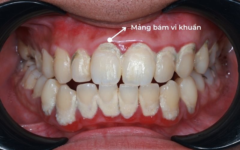 Nguyên Nhân Gây Viêm Lợi