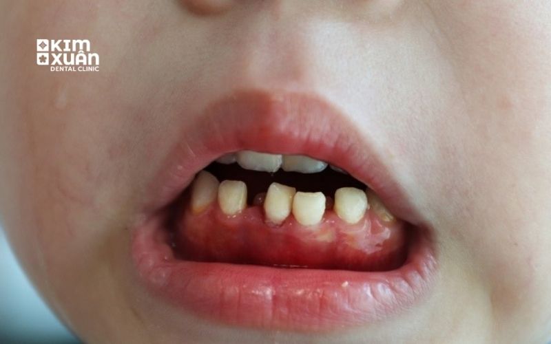 Nguyên Nhân Gây Viêm Lợi Ở Trẻ Em