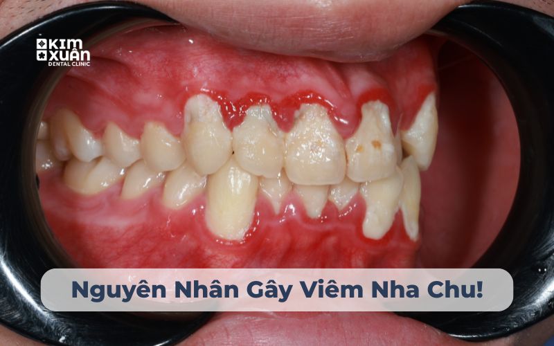 Nguyên nhân gây viêm nha chu