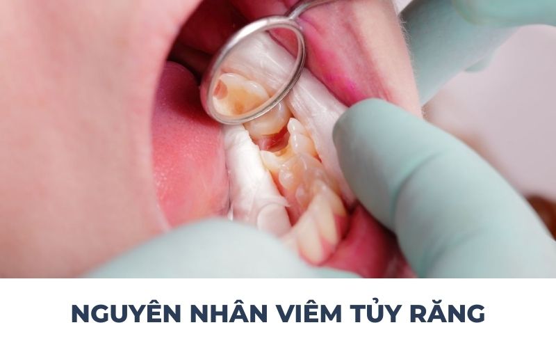 Nguyên Nhân Gây Viêm Tủy Răng
