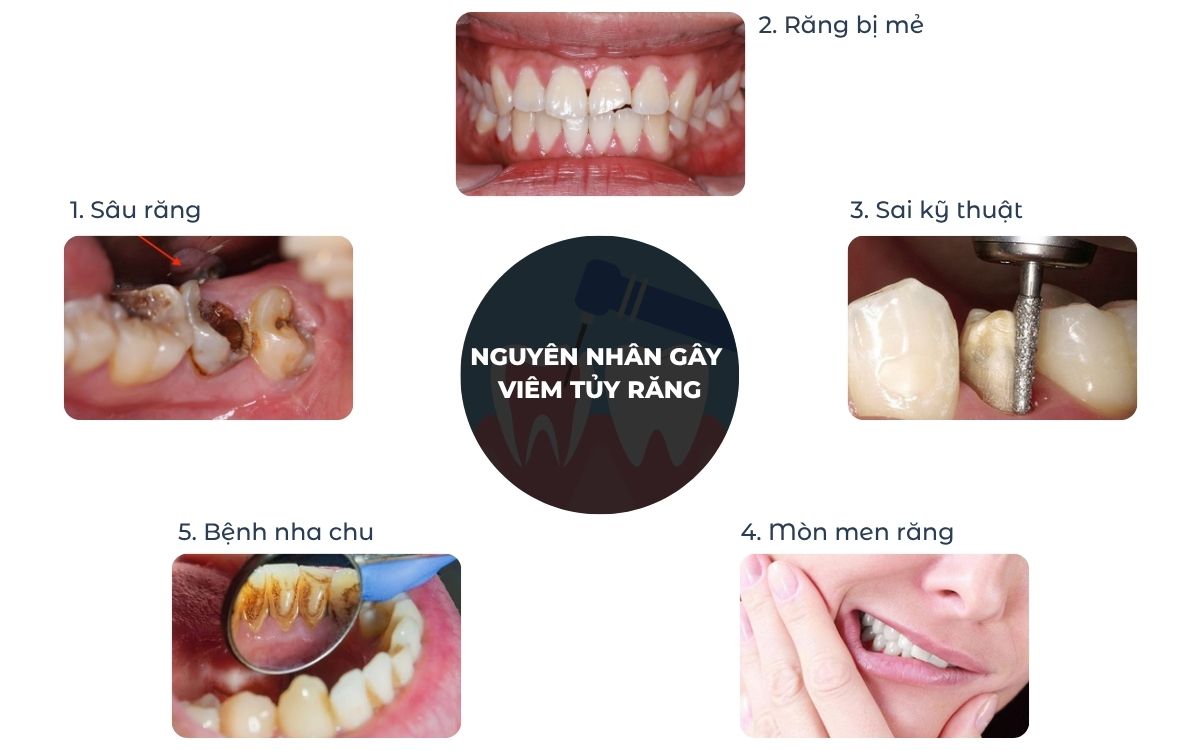 Nguyên Nhân Gây Viêm Tủy Răng