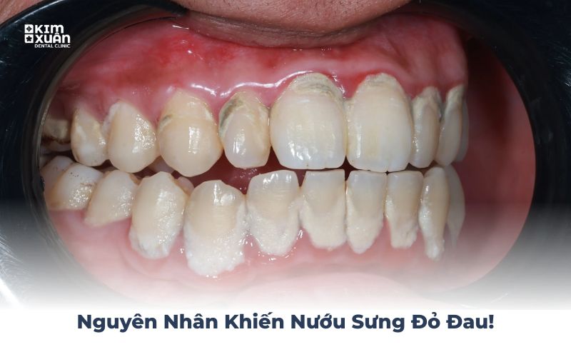 Nguyên Nhân Khiến Nướu Sưng Đỏ Đau