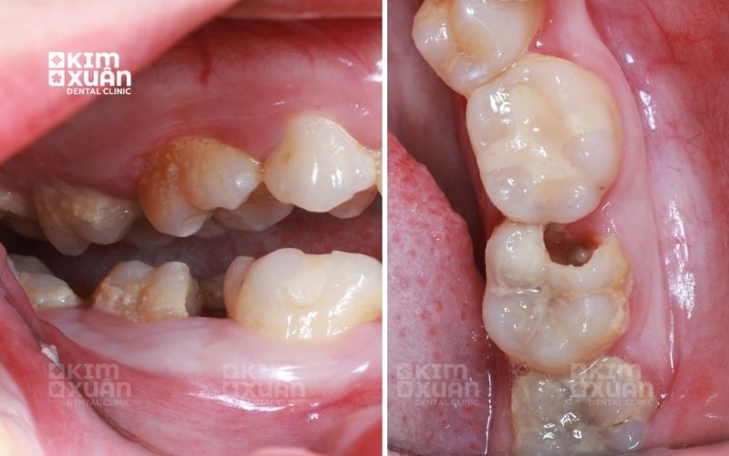 Nguyên Nhân Khiến Răng Chết Tủy