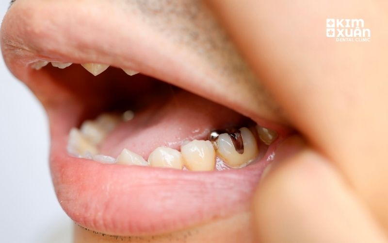 Nguyên Nhân Khiến Răng Trám Bị Nhức