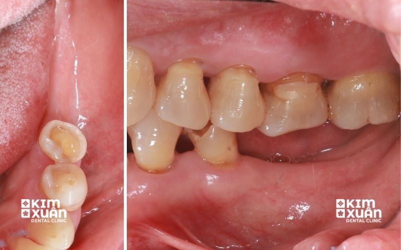 Nguyên Nhân Mất Răng lâu Năm