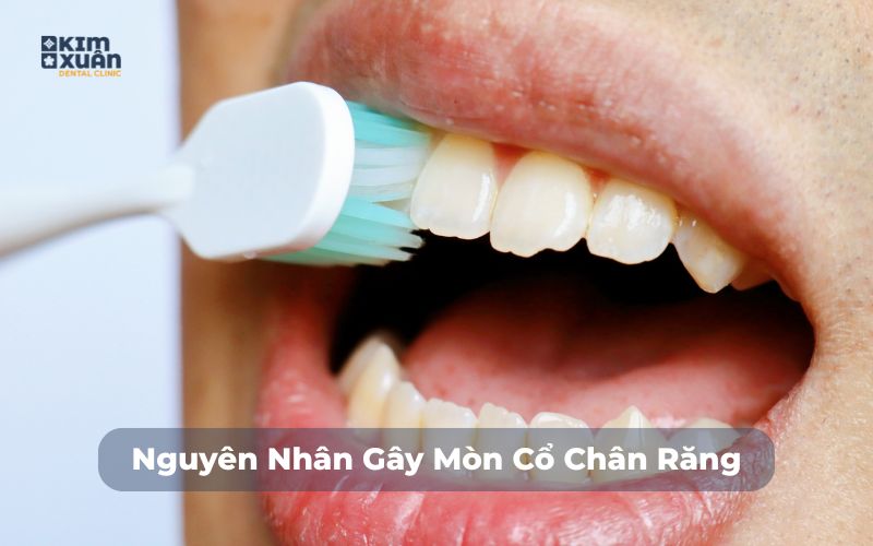 Nguyên nhân mòn cổ chân răng