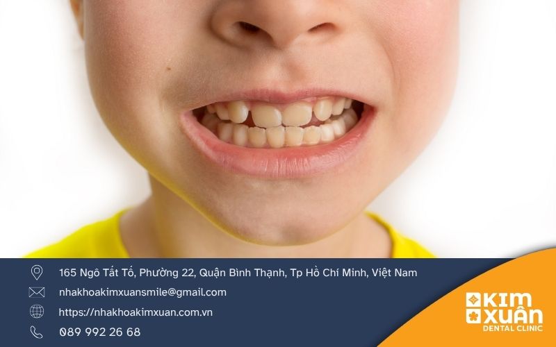 Nguyên Nhân Nghiến Răng Ở Trẻ Em