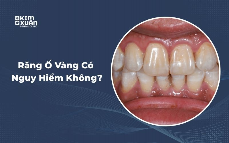 Nguyên Nhân Răng Bị Ố Vàng