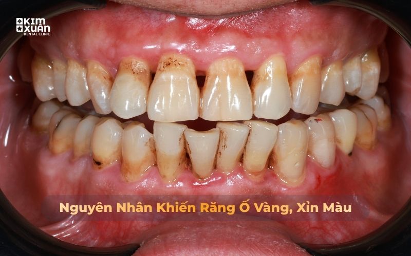 Nguyên nhân răng bị ố vàng