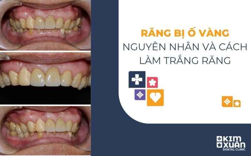 Nguyên Nhân Răng Bị Ố Vàng Và Cách Điều Trị