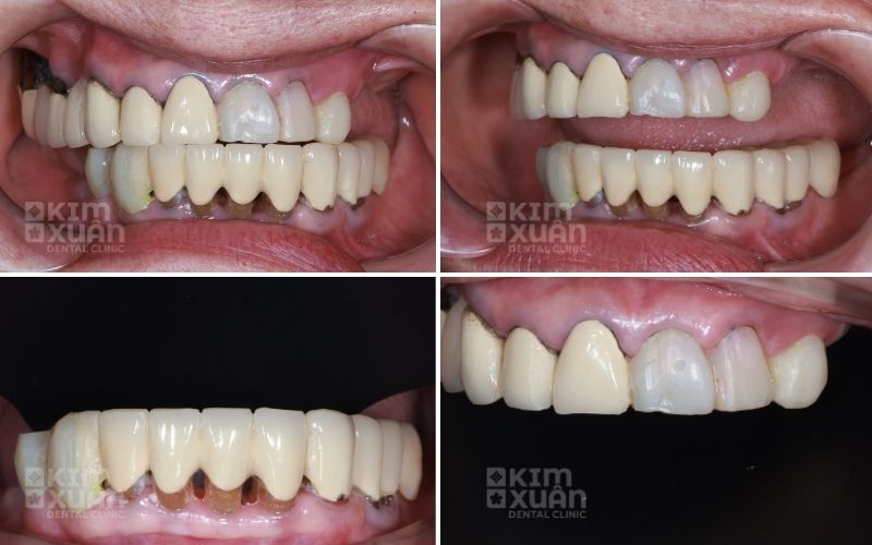 Nguyên Nhân Răng Bọc Sứ Bị Viêm Tủy