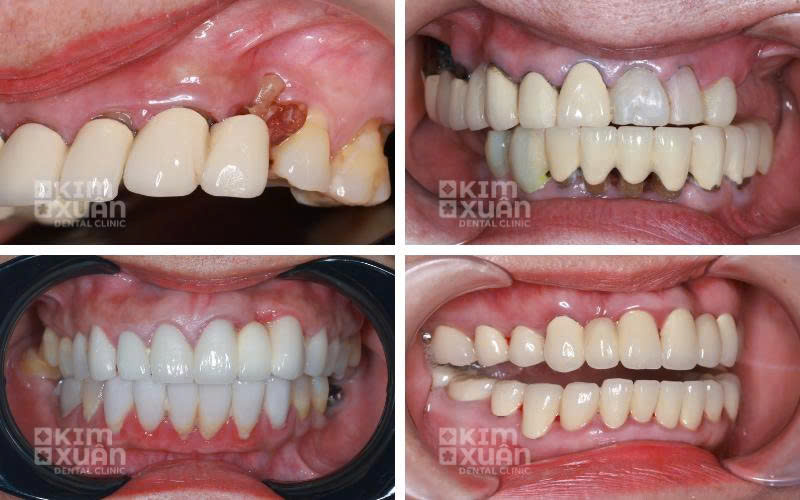 Nguyên Nhân Răng Bọc Sứ Lâu Năm Bị Đau Nhức