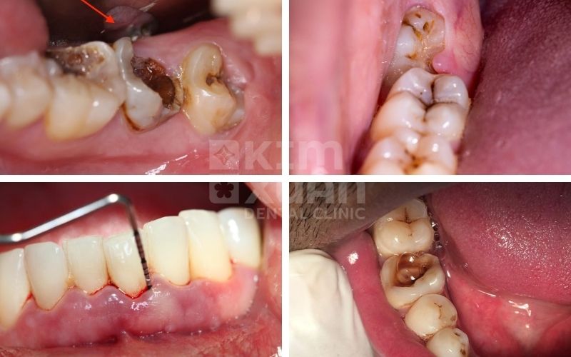 Nguyên Nhân Răng Cấm Và Răng Hàm Gây Đau Nhức