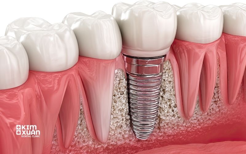 Nguyên Nhân Răng Implant Bị Lung Lay