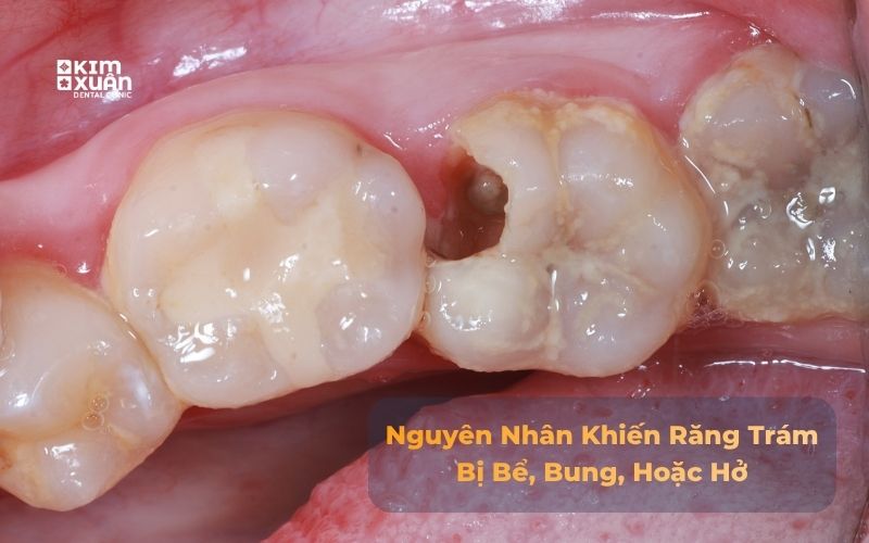 Nguyên nhân răng trám bị bung, bể, hở