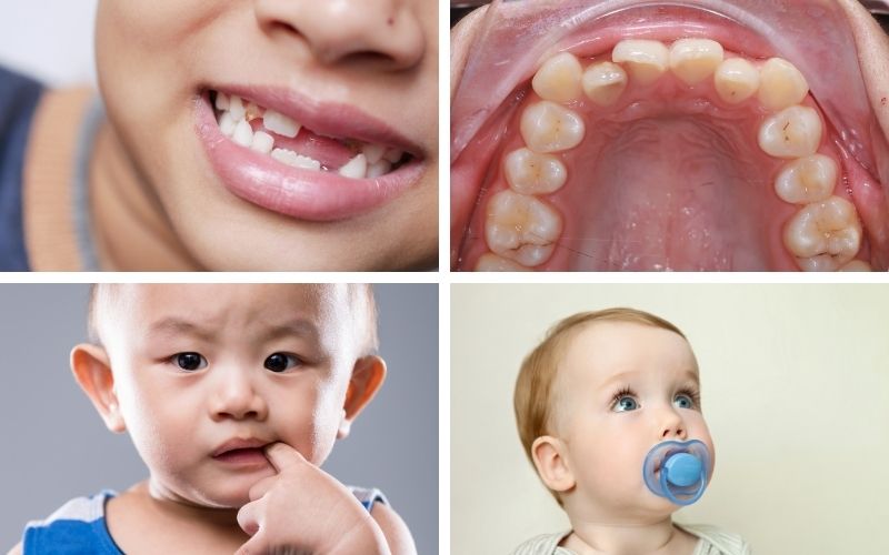 Nguyên Nhân Răng Vĩnh Viễn Mọc Lệch ở Trẻ Em