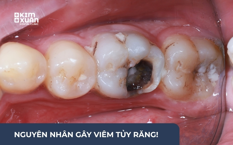 Nguyên Nhân Viêm Tủy Răng