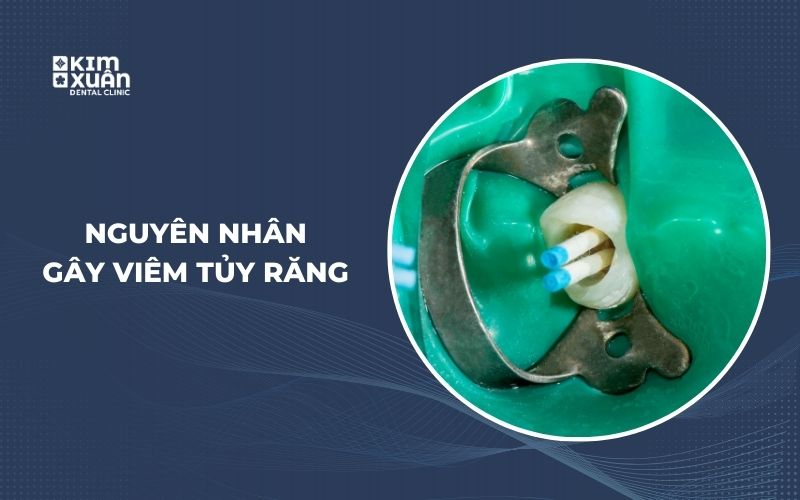 Nguyên Nhân Viêm tủy Răng