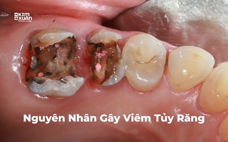 Nguyên Nhân Viêm Tủy Răng