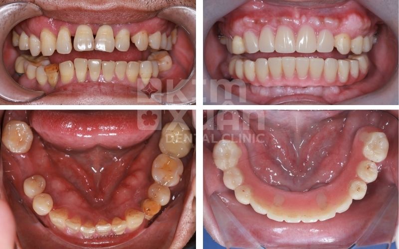 Nhổ Răng Bao Lâu Thì Trồng Răng Implant Tốt Nhất