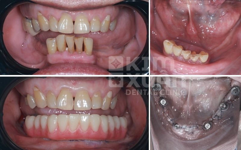 Nhổ Răng Bao Lâu Thì Trồng Răng Implant Được Ảnh Trước Và Sau