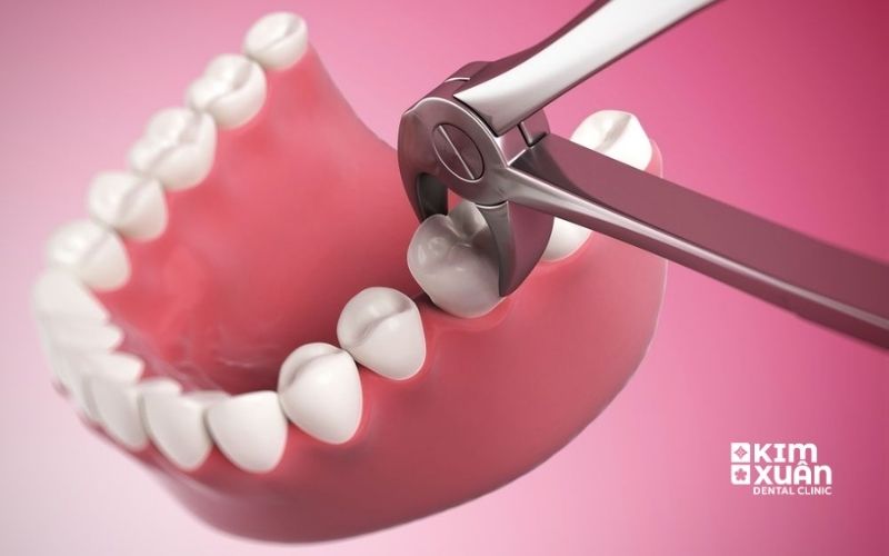 Nhổ Răng Cấm Bị Sâu Có Đau Không