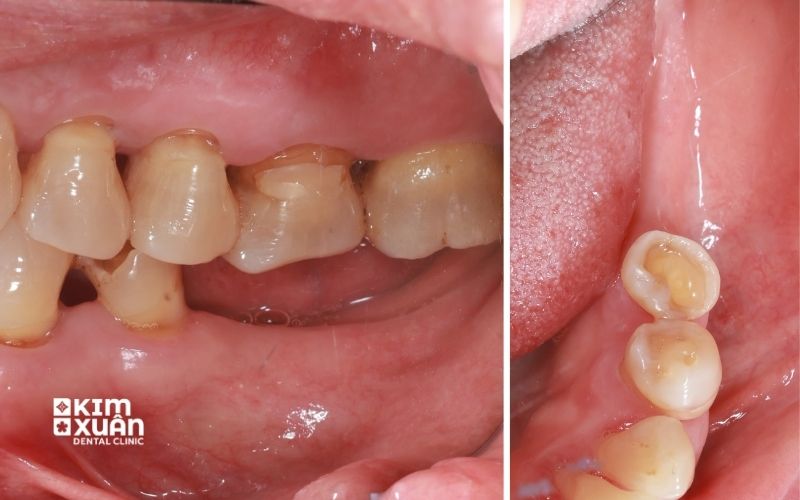 Nhổ Răng Cấm Bị Sâu Giá Bao Nhiêu