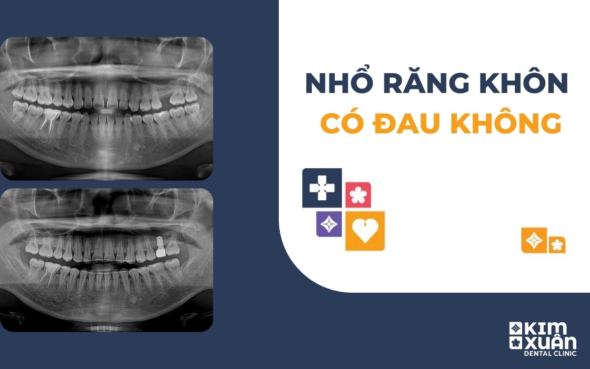 Nhổ Răng Khôn Có Đau Không