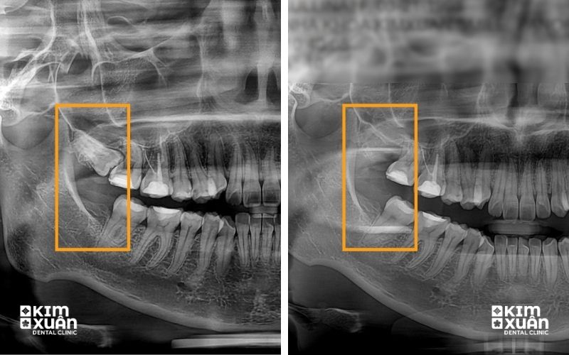 Nhổ Răng Khôn Giá Bao Nhiêu Tại TP.HCM
