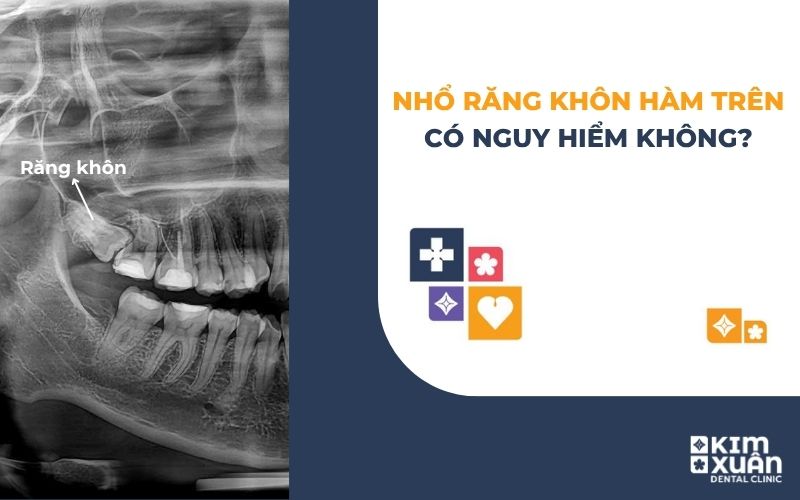 Nhổ răng khôn hàm trên có nguy hiểm không