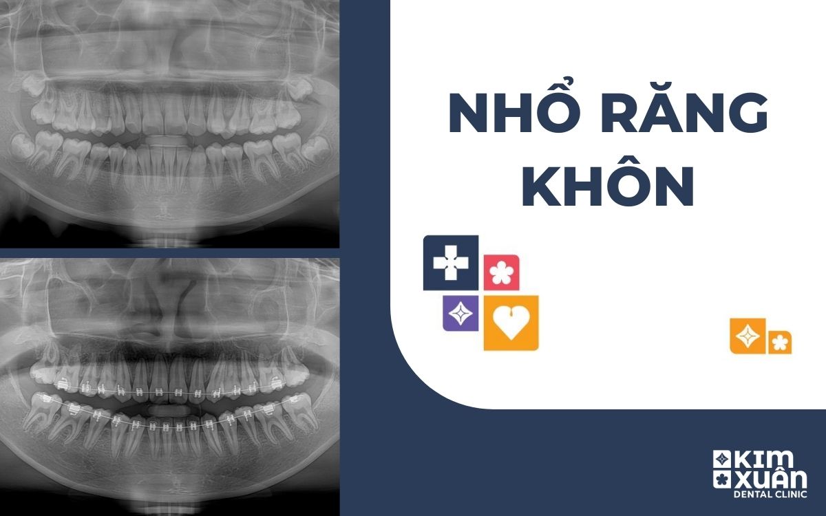 Nhổ Răng Khôn (Răng Số 8)