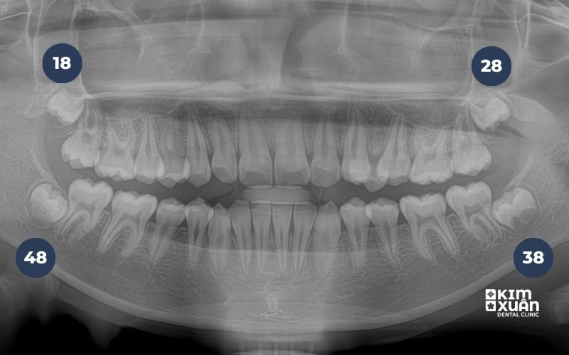 Nhổ Răng khôn Mọc Ngầm Giá Bao Nhiêu Tiền