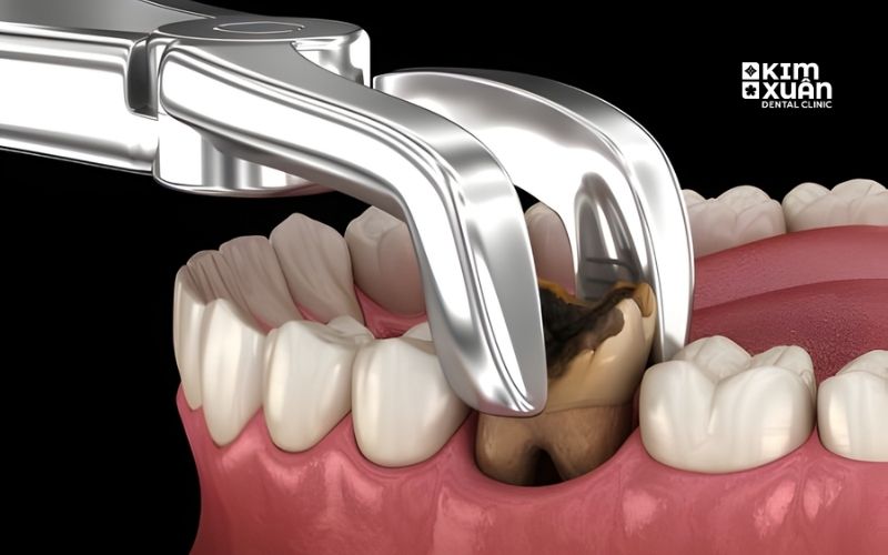 Nhổ Răng Sâu Có Ảnh Hưởng Gì Không