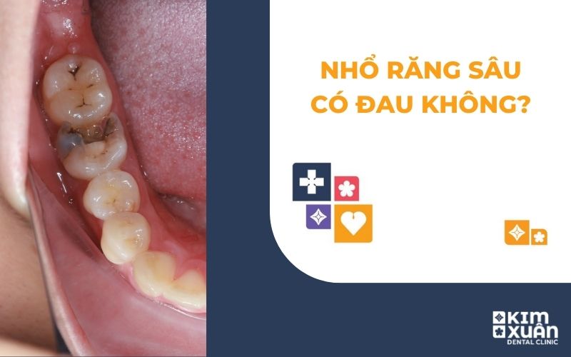 Nhổ Răng Sâu Có Đau Không