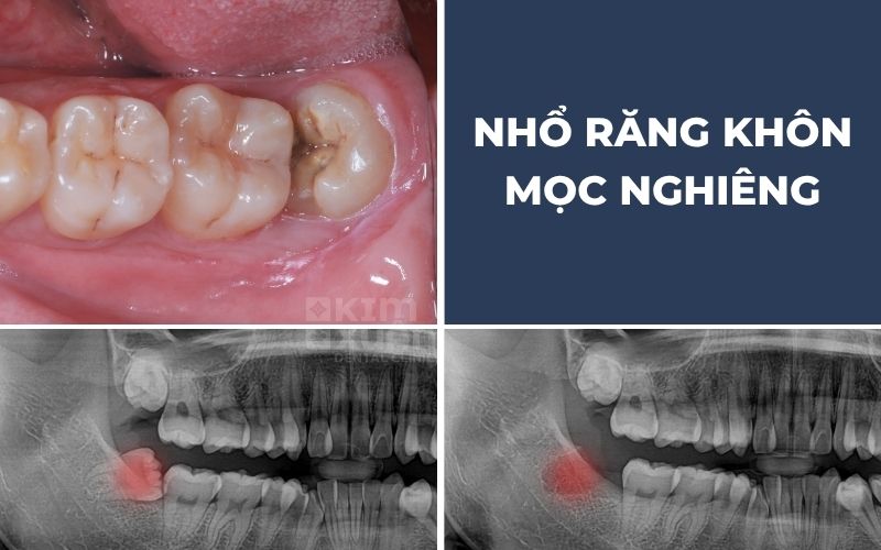 Nhổ Răng Sâu Giá Bao Nhiêu
