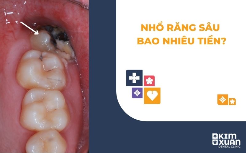 Nhổ Răng Sâu Giá Bao Nhiêu