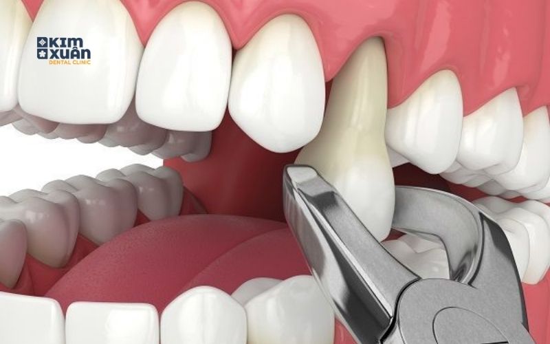 Nhổ Răng Sâu Giá Bao Nhiêu Tiền