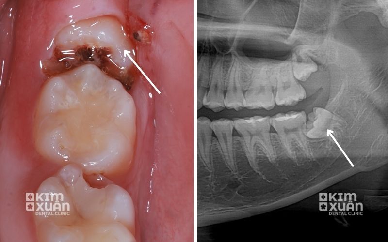 Nhổ Răng Sâu Giá Bao Nhiêu tiền Tại TP. HCM