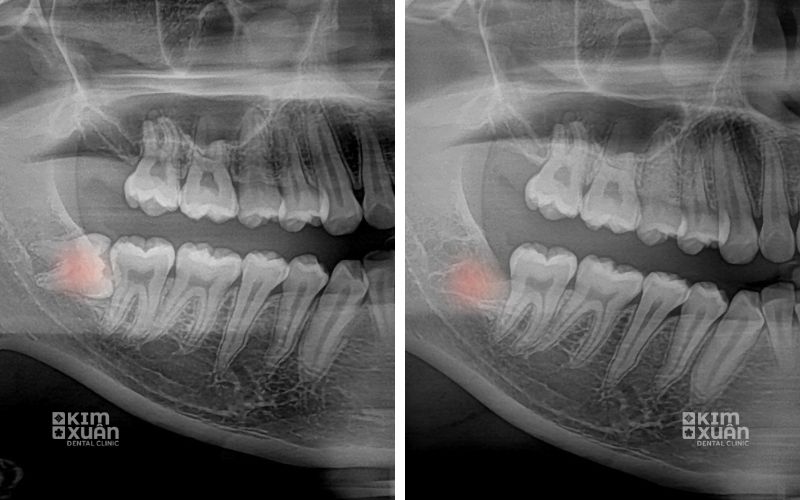 Nhổ Răng Số 8 Bị Sâu Giá Bao Nhiêu Tiền