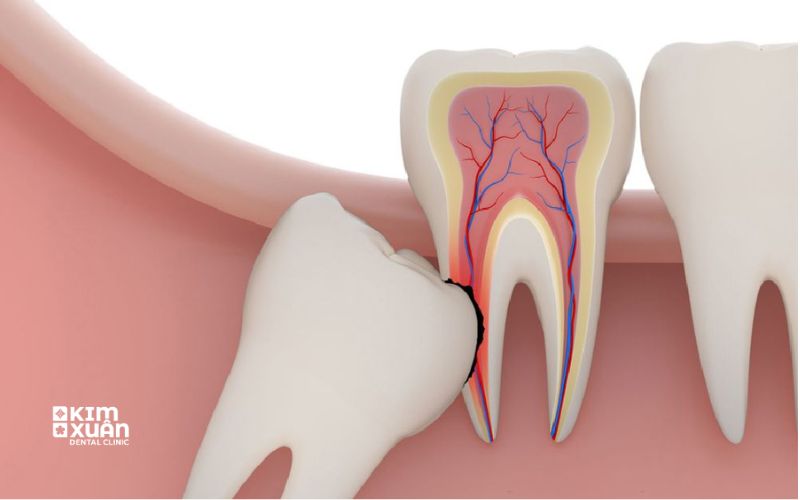 Nhổ Răng Số 8 Giá Bao Nhiêu