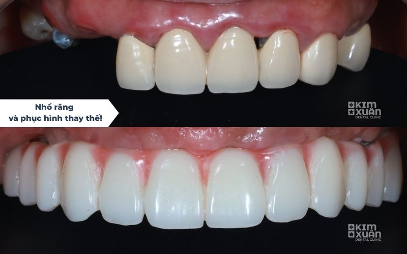 Nhổ Răng Và Phục Hình Răng Implant