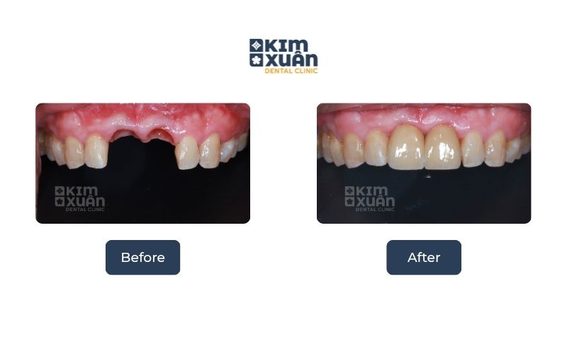 Những Ai Nên Trồng Răng Implant