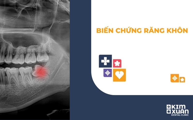 Những Biến Chứng Khi Mọc Răng Khôn