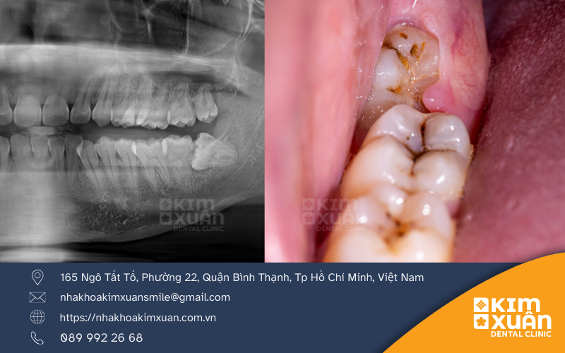 Những Biến Chứng Khi Mọc Răng Khôn
